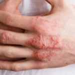 كيف تفرّق بين الصدفية والإكزيما؟