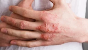 كيف تفرّق بين الصدفية والإكزيما؟