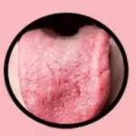 تشققات اللسان كعلامة على سوء التغذية