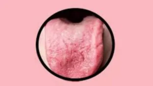 تشققات اللسان كعلامة على سوء التغذية