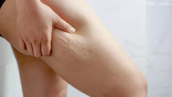 الوذمة الشحمية: علامات تشير إلى اضطراب الليبوديما