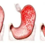 التهاب المعدة: الأسباب والأعراض والعلاج