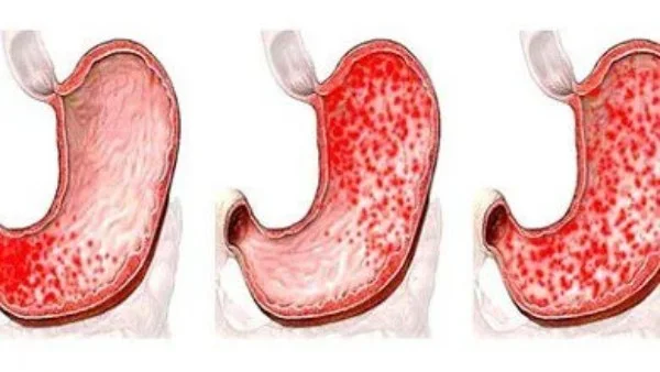 التهاب المعدة: الأسباب والأعراض والعلاج