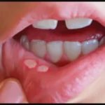 وداعًا لقرح الفم: حلول طبيعية من مطبخك