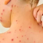الجدري المائي: مرض شائع يجب الحذر منه
