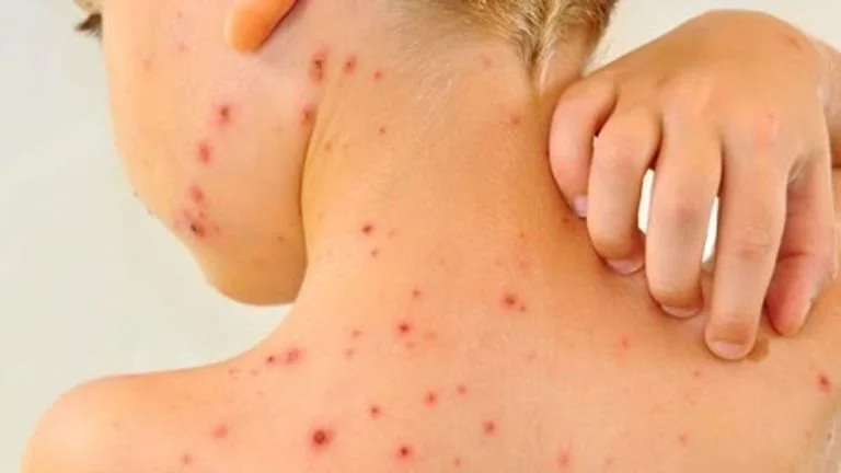 الجدري المائي: مرض شائع يجب الحذر منه