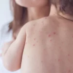 أسباب تقصف الأظافر والجدري المائي هاجم الأطفال