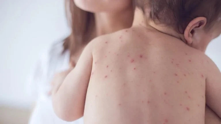 أسباب تقصف الأظافر والجدري المائي هاجم الأطفال