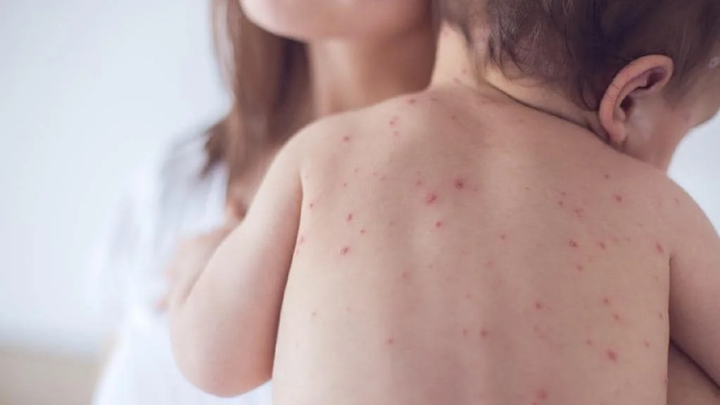 أسباب تقصف الأظافر والجدري المائي هاجم الأطفال