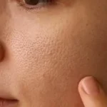 وصفات طبيعية لعلاج المسام الواسعة