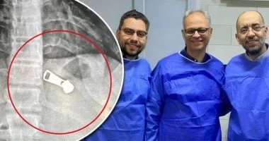 استخراج جسم معدني من معدة طفلة في مستشفى دسوق العام