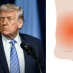 صحة ترامب: تورم الكاحل ومشاكل مشيته