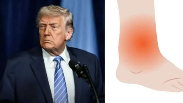 صحة ترامب: تورم الكاحل ومشاكل مشيته