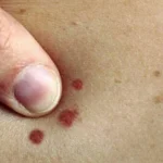 علامات تحذيرية على الجلد تشير إلى سرطان الجلد