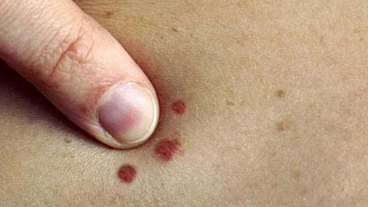 علامات تحذيرية على الجلد تشير إلى سرطان الجلد