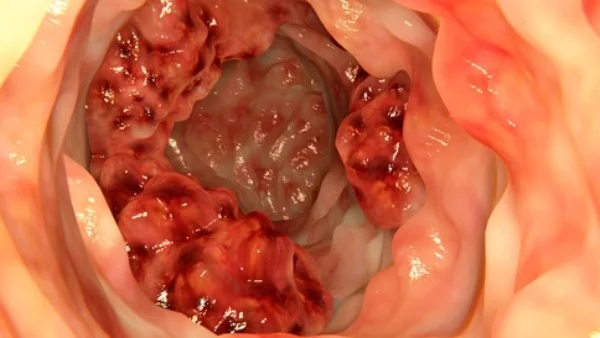 علامات تدل على سرطان القولون