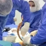 إنقاذ قدم طفل بمستشفى دسوق العام بعد إصابة خطيرة