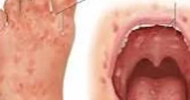 تعليق الدراسة في ليما ببيرو بسبب فيروس كوكساكي