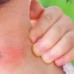 لماذا ينجذب البعوض لبعض البشر أكثر من غيرهم؟
