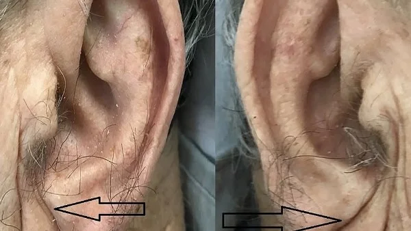 تجعيدة الأذن وارتباطها بأمراض القلب