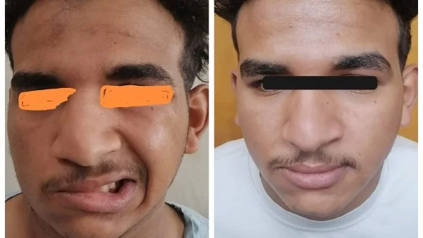إنجاز طبي في جامعة أسيوط يعيد وظائف العصب الوجهي