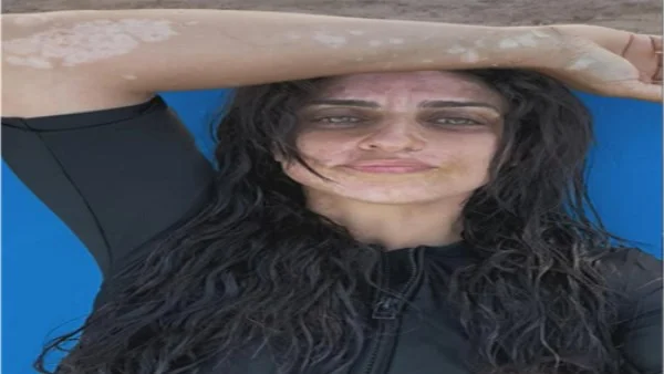 أمير كرارة يدعم شقيقته نسرين بعد حديثها عن البهاق