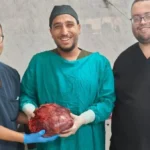 نجاح استئصال ورم مبيضي ضخم في جامعة أسيوط