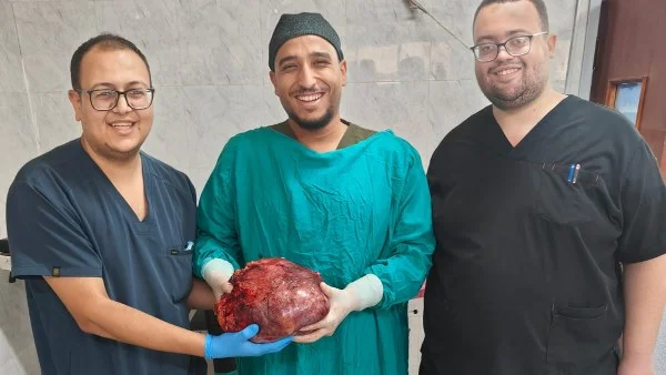 نجاح استئصال ورم مبيضي ضخم في جامعة أسيوط
