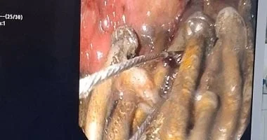 إنقاذ حياة مريض في بني سويف باستخراج 100 مسمار من معدته