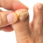 فطريات أظافر القدم: أسباب وطرق علاج شائعة