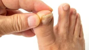 فطريات أظافر القدم: أسباب وطرق علاج شائعة