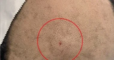 نجاح جراحة دقيقة في المنصورة لإنقاذ حياة طفل