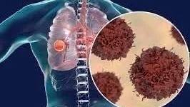 علامات غير متوقعة تشير لسرطان الرئة