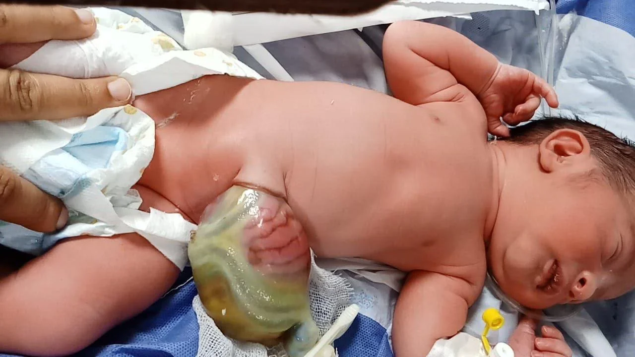 نجاح جراحة لإنقاذ طفل حديث الولادة بالشرقية