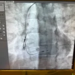 نجاح زراعة منظم ضربات قلب بتقنية حديثة بكفر الشيخ