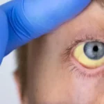 أعراض التهاب الكبد وأهميتها في اليوم العالمي له